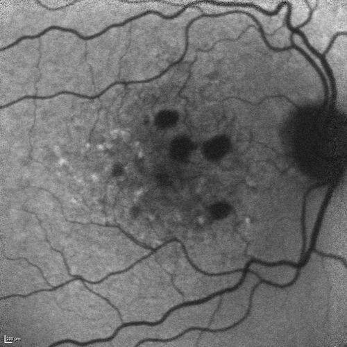 Dry AMD - Confluent Drusen Sparing Center of Macula which has Atrophy
65 year old woman, VA 20/40 OD; 20/80 OS.  The center of the macula has few or no drusen with predominantly non-geographic atrophy
