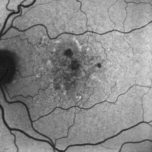 Dry AMD - Confluent Drusen Sparing Center of Macula which has Atrophy
65 year old woman, VA 20/40 OD; 20/80 OS.  The center of the macula has few or no drusen with predominantly non-geographic atrophy
