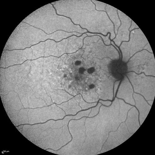 Dry AMD - Confluent Drusen Sparing Center of Macula which has Atrophy
65 year old woman, VA 20/40 OD; 20/80 OS.  The center of the macula has few or no drusen with predominantly non-geographic atrophy

