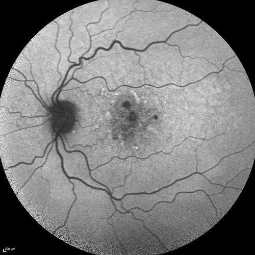 Dry AMD - Confluent Drusen Sparing Center of Macula which has Atrophy
65 year old woman, VA 20/40 OD; 20/80 OS.  The center of the macula has few or no drusen with predominantly non-geographic atrophy
