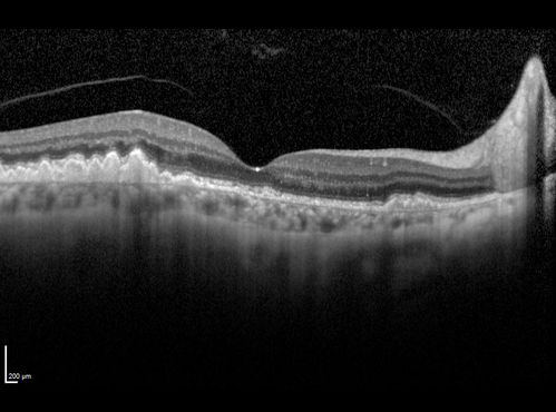 Dry AMD - Confluent Drusen Sparing Center of Macula which has Atrophy
65 year old woman, VA 20/40 OD; 20/80 OS.  The center of the macula has few or no drusen with predominantly non-geographic atrophy
