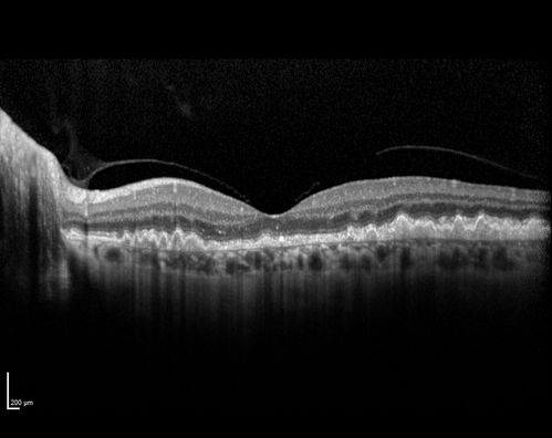 Dry AMD - Confluent Drusen Sparing Center of Macula which has Atrophy
65 year old woman, VA 20/40 OD; 20/80 OS.  The center of the macula has few or no drusen with predominantly non-geographic atrophy
