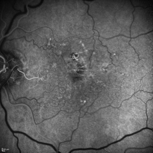 Dry AMD - Confluent Drusen Sparing Center of Macula which has Atrophy
65 year old woman, VA 20/40 OD; 20/80 OS.  The center of the macula has few or no drusen with predominantly non-geographic atrophy
