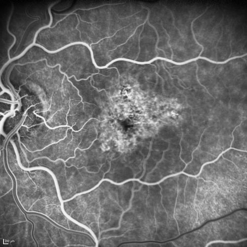 Dry AMD - Confluent Drusen Sparing Center of Macula which has Atrophy
65 year old woman, VA 20/40 OD; 20/80 OS.  The center of the macula has few or no drusen with predominantly non-geographic atrophy
