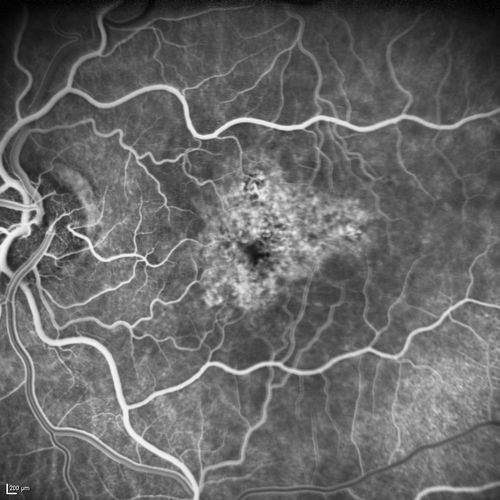 Dry AMD - Confluent Drusen Sparing Center of Macula which has Atrophy
65 year old woman, VA 20/40 OD; 20/80 OS.  The center of the macula has few or no drusen with predominantly non-geographic atrophy
