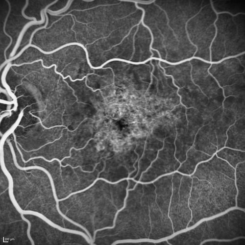 Dry AMD - Confluent Drusen Sparing Center of Macula which has Atrophy
65 year old woman, VA 20/40 OD; 20/80 OS.  The center of the macula has few or no drusen with predominantly non-geographic atrophy
