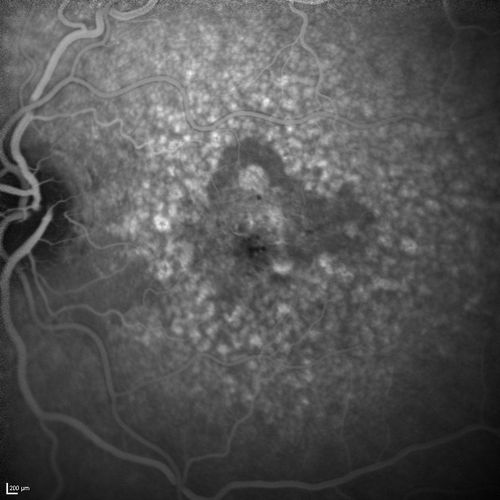 Dry AMD - Confluent Drusen Sparing Center of Macula which has Atrophy
65 year old woman, VA 20/40 OD; 20/80 OS.  The center of the macula has few or no drusen with predominantly non-geographic atrophy
