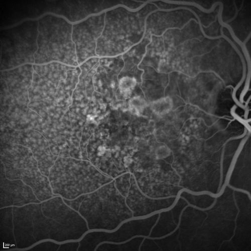 Dry AMD - Confluent Drusen Sparing Center of Macula which has Atrophy
65 year old woman, VA 20/40 OD; 20/80 OS.  The center of the macula has few or no drusen with predominantly non-geographic atrophy
