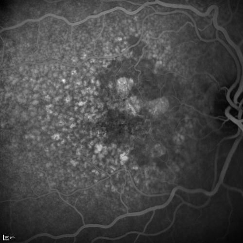 Dry AMD - Confluent Drusen Sparing Center of Macula which has Atrophy
65 year old woman, VA 20/40 OD; 20/80 OS.  The center of the macula has few or no drusen with predominantly non-geographic atrophy
