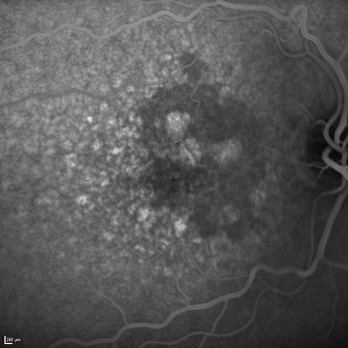 Dry AMD - Confluent Drusen Sparing Center of Macula which has Atrophy
65 year old woman, VA 20/40 OD; 20/80 OS.  The center of the macula has few or no drusen with predominantly non-geographic atrophy
