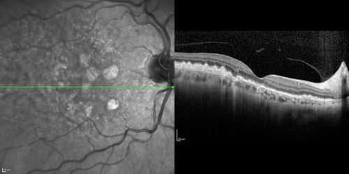 Dry AMD - Confluent Drusen Sparing Center of Macula which has Atrophy
65 year old woman, VA 20/40 OD; 20/80 OS.  The center of the macula has few or no drusen with predominantly non-geographic atrophy
