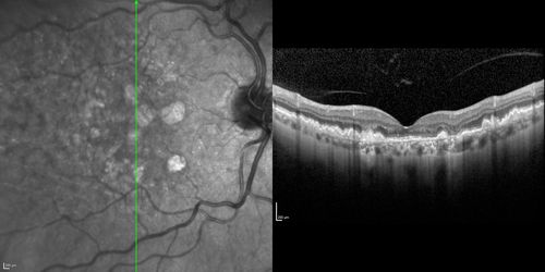 Dry AMD - Confluent Drusen Sparing Center of Macula which has Atrophy
65 year old woman, VA 20/40 OD; 20/80 OS.  The center of the macula has few or no drusen with predominantly non-geographic atrophy
