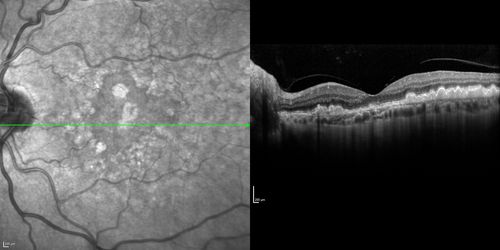 Dry AMD - Confluent Drusen Sparing Center of Macula which has Atrophy
65 year old woman, VA 20/40 OD; 20/80 OS.  The center of the macula has few or no drusen with predominantly non-geographic atrophy
