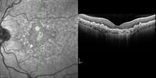 Dry AMD - Confluent Drusen Sparing Center of Macula which has Atrophy
65 year old woman, VA 20/40 OD; 20/80 OS.  The center of the macula has few or no drusen with predominantly non-geographic atrophy
