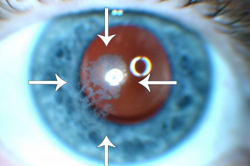 Post Lasik Epithelial Ingrowth
58-year-old man had a vitrectomy for a macular pucker in the right eye almost two years ago.  His vision was good after his cornea surgeon removed the cells from his flap but then recently the cells have regrown and his vision has declined again.
OD is 20/100.
