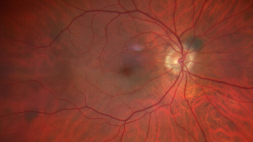 Cilioretinal artery occlusion following cataract surgery
60 year old man noticed new scotoma in the right eye immediately after cataract surgery.  Vision is 20/60
