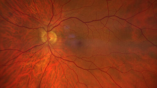 Cilioretinal artery occlusion following cataract surgery
60 year old man noticed new scotoma in the right eye immediately after cataract surgery.  Vision is 20/60

