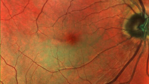 Cilioretinal artery occlusion following cataract surgery
60 year old man noticed new scotoma in the right eye immediately after cataract surgery.  Vision is 20/60
