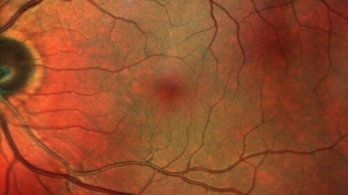 Cilioretinal artery occlusion following cataract surgery
60 year old man noticed new scotoma in the right eye immediately after cataract surgery.  Vision is 20/60
