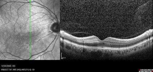 Cilioretinal artery occlusion following cataract surgery
60 year old man noticed new scotoma in the right eye immediately after cataract surgery.  Vision is 20/60
