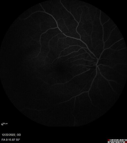 Cilioretinal artery occlusion following cataract surgery
60 year old man noticed new scotoma in the right eye immediately after cataract surgery.  Vision is 20/60

