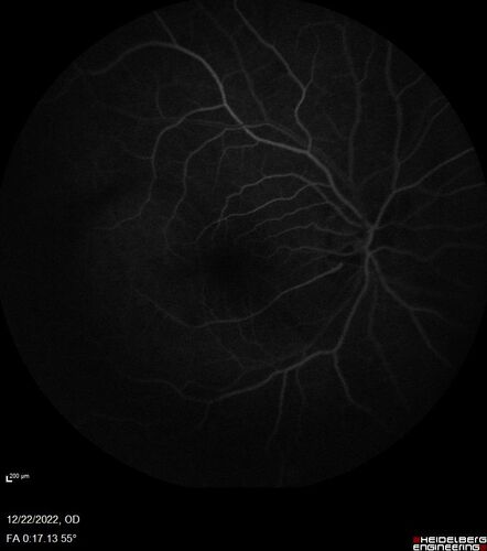 Cilioretinal artery occlusion following cataract surgery
60 year old man noticed new scotoma in the right eye immediately after cataract surgery.  Vision is 20/60
