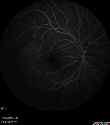 Cilioretinal artery occlusion following cataract surgery
60 year old man noticed new scotoma in the right eye immediately after cataract surgery.  Vision is 20/60
