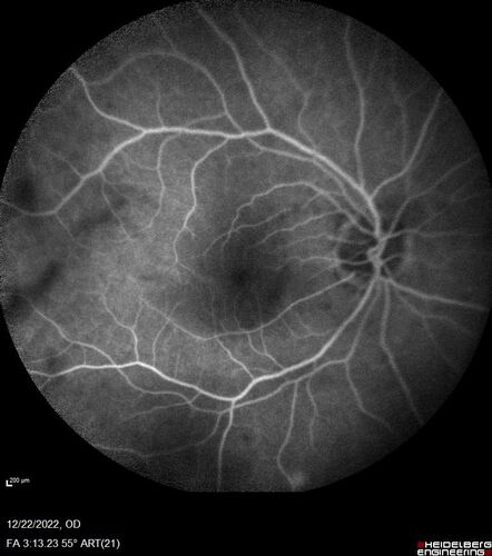 Cilioretinal artery occlusion following cataract surgery
60 year old man noticed new scotoma in the right eye immediately after cataract surgery.  Vision is 20/60

