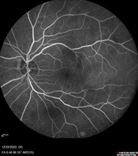 Cilioretinal artery occlusion following cataract surgery
60 year old man noticed new scotoma in the right eye immediately after cataract surgery.  Vision is 20/60
