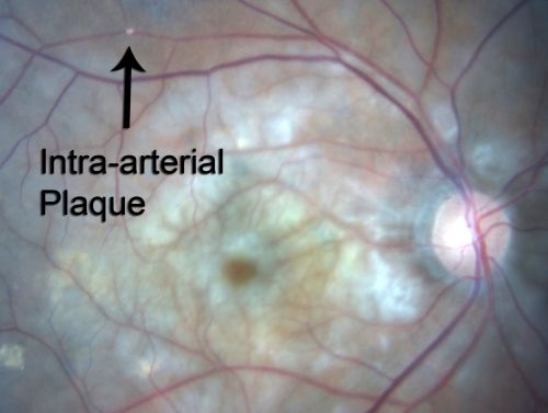 80 Year old man with 3 day history of vision loss right eye.  Vision 4/200.
