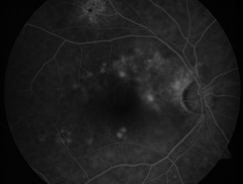 80 Year old man with 3 day history of vision loss right eye.  Vision 4/200.
