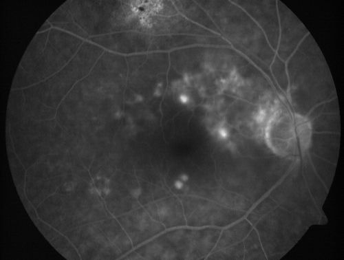 80 Year old man with 3 day history of vision loss right eye.  Vision 4/200.
