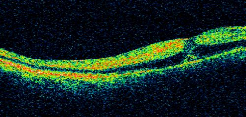 80 Year old man with 3 day history of vision loss right eye.  Vision 4/200.
