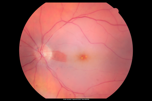 Central Retinal Artery Occlusion with Cilioretinal Sparing - Acute
 77-year-old man was doing fine until midnight of last night when he noticed sudden severe vision loss in the left eye. VISUAL ACUITY:  OD 20/20,  OS 2/200.
