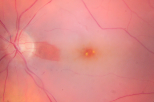 Central Retinal Artery Occlusion with Cilioretinal Sparing - Acute
 77-year-old man was doing fine until midnight of last night when he noticed sudden severe vision loss in the left eye. VISUAL ACUITY:  OD 20/20,  OS 2/200.
