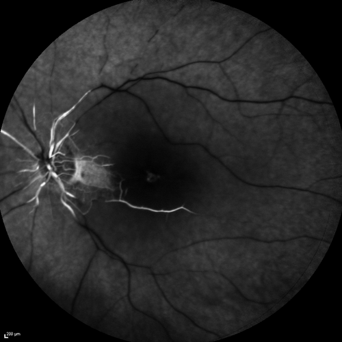 Central Retinal Artery Occlusion with Cilioretinal Sparing - Acute - FA Very Slow Filling CRA
 77-year-old man was doing fine until midnight of last night when he noticed sudden severe vision loss in the left eye. VISUAL ACUITY:  OD 20/20,  OS 2/200.
