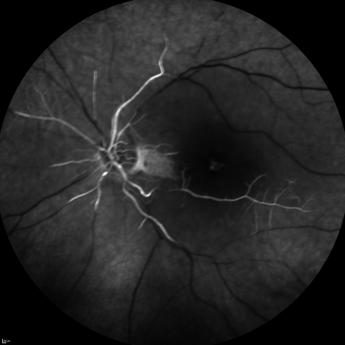 Central Retinal Artery Occlusion with Cilioretinal Sparing - Acute - FA Very Slow Filling CRA
 77-year-old man was doing fine until midnight of last night when he noticed sudden severe vision loss in the left eye. VISUAL ACUITY:  OD 20/20,  OS 2/200.
