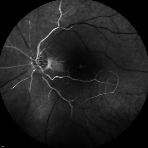 Central Retinal Artery Occlusion with Cilioretinal Sparing - Acute - FA Very Slow Filling CRA
 77-year-old man was doing fine until midnight of last night when he noticed sudden severe vision loss in the left eye. VISUAL ACUITY:  OD 20/20,  OS 2/200.
