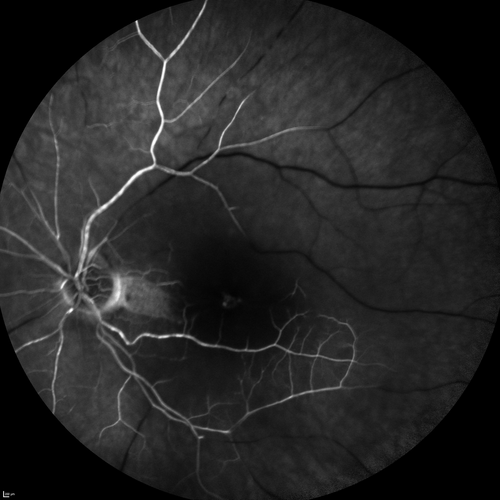 Central Retinal Artery Occlusion with Cilioretinal Sparing - Acute - FA Very Slow Filling CRA
 77-year-old man was doing fine until midnight of last night when he noticed sudden severe vision loss in the left eye. VISUAL ACUITY:  OD 20/20,  OS 2/200.

