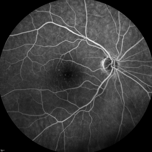 Central Retinal Artery Occlusion with Cilioretinal Sparing - Acute
 77-year-old man was doing fine until midnight of last night when he noticed sudden severe vision loss in the left eye. VISUAL ACUITY:  OD 20/20,  OS 2/200.
