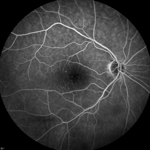 Central Retinal Artery Occlusion with Cilioretinal Sparing - Acute
 77-year-old man was doing fine until midnight of last night when he noticed sudden severe vision loss in the left eye. VISUAL ACUITY:  OD 20/20,  OS 2/200.
