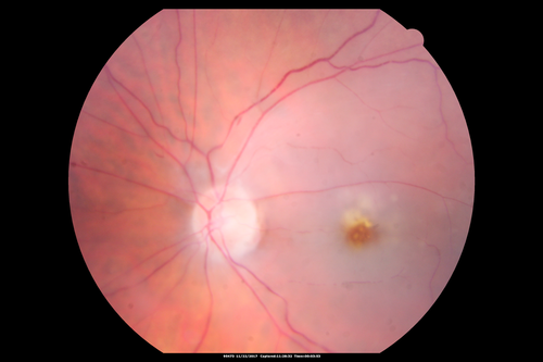 Central Retinal Artery Occlusion then Neovascular Glaucoma
81  year old male with sudden vision loss. 2 months later developed NVG
