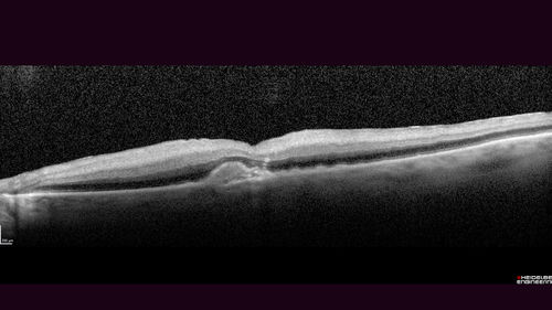 Central Retinal Artery Occlusion then Neovascular Glaucoma
81  year old male with sudden vision loss. 2 months later developed NVG
