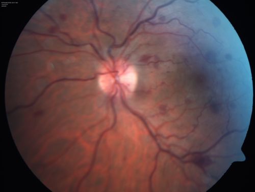 Central retinal artery and vein occlusion - Protein C Deficiency 33 year old male
33 year old male with vision loss for 3 hours.  VA 20/12 right eye, 5/200 left eye.  He has a protein C deficiency.  The left eye recovered vision in about 1 month to 20/16.  FA shows very slow recirculation time.
