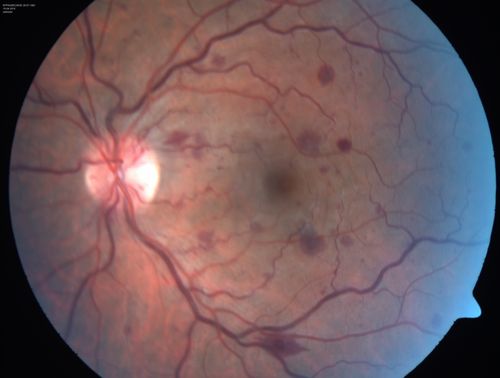 Central retinal artery and vein occlusion - Protein C Deficiency 33 year old male
33 year old male with vision loss for 3 hours.  VA 20/12 right eye, 5/200 left eye.  He has a protein C deficiency.  The left eye recovered vision in about 1 month to 20/16.  FA shows very slow recirculation time.
