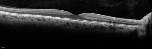 Central retinal artery and vein occlusion - Protein C Deficiency 33 year old male
33 year old male with vision loss for 3 hours.  VA 20/12 right eye, 5/200 left eye.  He has a protein C deficiency.  The left eye recovered vision in about 1 month to 20/16.  FA shows very slow recirculation time.
