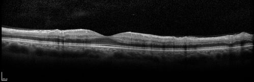 Central retinal artery and vein occlusion - Protein C Deficiency 33 year old male
33 year old male with vision loss for 3 hours.  VA 20/12 right eye, 5/200 left eye.  He has a protein C deficiency.  The left eye recovered vision in about 1 month to 20/16.  FA shows very slow recirculation time.
