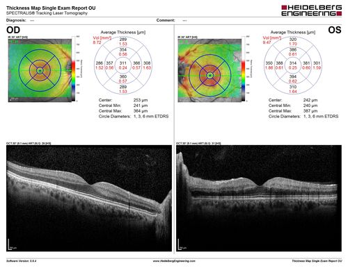 Central retinal artery and vein occlusion - Protein C Deficiency 33 year old male
33 year old male with vision loss for 3 hours.  VA 20/12 right eye, 5/200 left eye.  He has a protein C deficiency.  The left eye recovered vision in about 1 month to 20/16.  FA shows very slow recirculation time.
