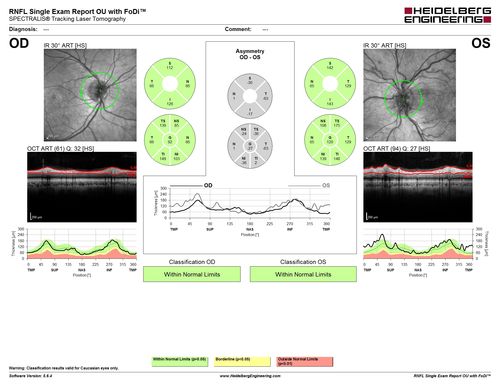 Central retinal artery and vein occlusion - Protein C Deficiency 33 year old male
33 year old male with vision loss for 3 hours.  VA 20/12 right eye, 5/200 left eye.  He has a protein C deficiency.  The left eye recovered vision in about 1 month to 20/16.  FA shows very slow recirculation time.
