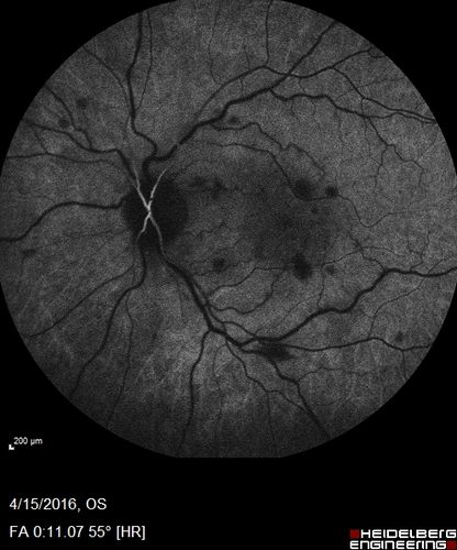 Central retinal artery and vein occlusion - Protein C Deficiency 33 year old male
33 year old male with vision loss for 3 hours.  VA 20/12 right eye, 5/200 left eye.  He has a protein C deficiency.  The left eye recovered vision in about 1 month to 20/16.  FA shows very slow recirculation time.
